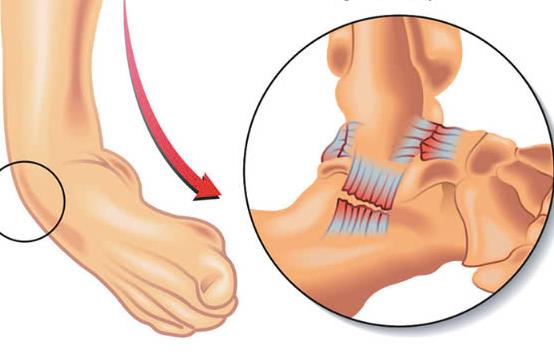 Đứt dây chằng cổ chân